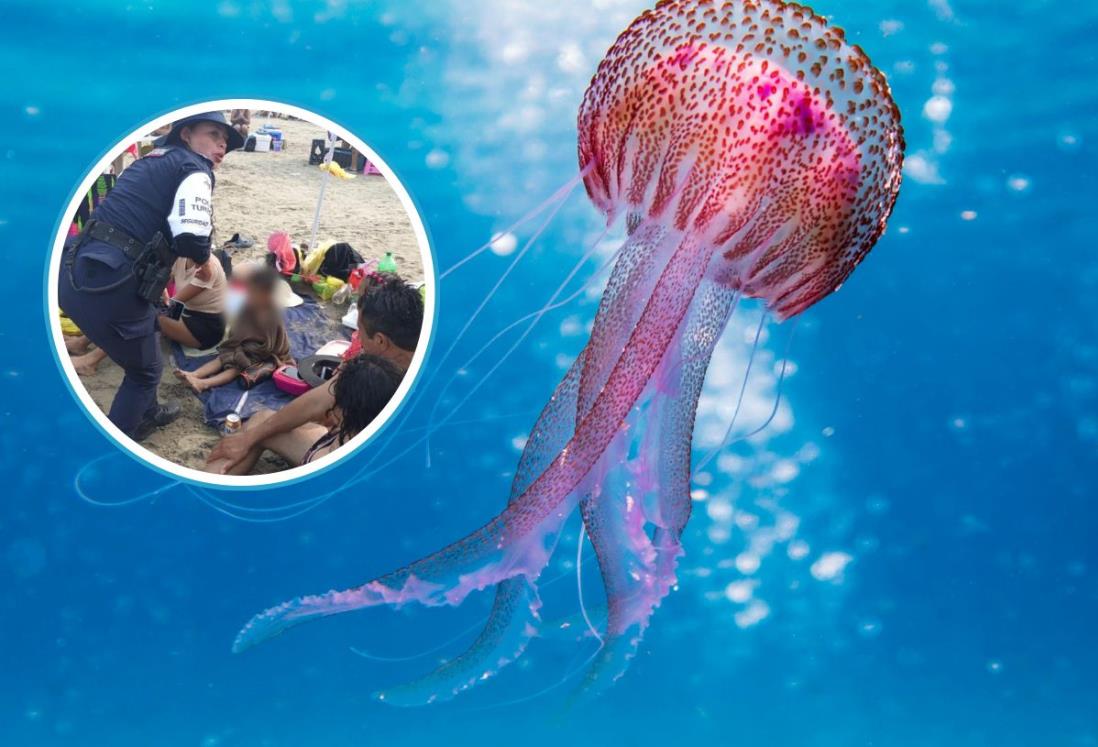 ¿Qué tan grave es la picadura de medusas en Veracruz y qué primeros auxilios se deben dar?
