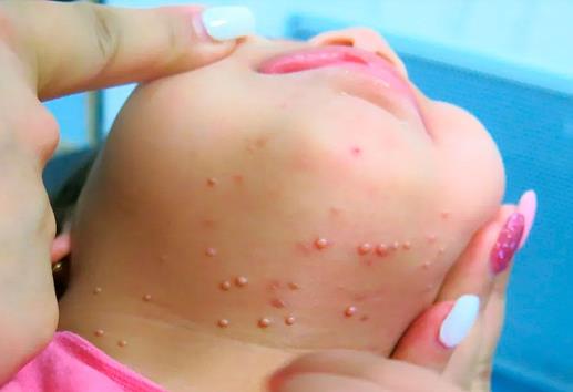 Molusco contagioso, el virus de piel por contagio en piscinas y gimnasios