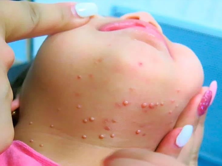 Molusco contagioso, el virus de piel por contagio en piscinas y gimnasios