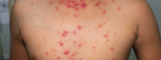 Molusco contagioso, el virus de piel por contagio en piscinas y gimnasios