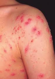 Molusco contagioso, el virus de piel por contagio en piscinas y gimnasios