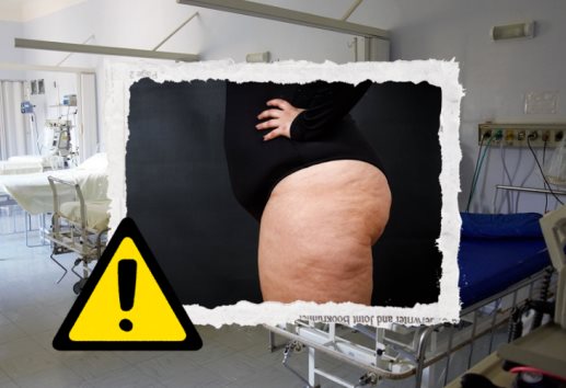 ¿Qué es el lipedema?: IMSS Veracruz Norte llama a diagnostico temprano