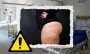¿Qué es el lipedema?: IMSS Veracruz Norte llama a diagnostico temprano