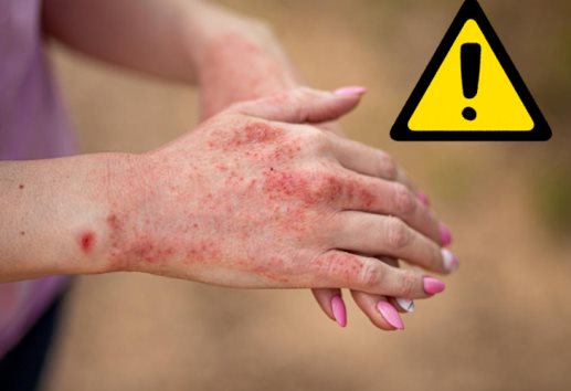 ¿Qué es el lupus?: IMSS Veracruz Norte llama a prevenir esta enfermedad