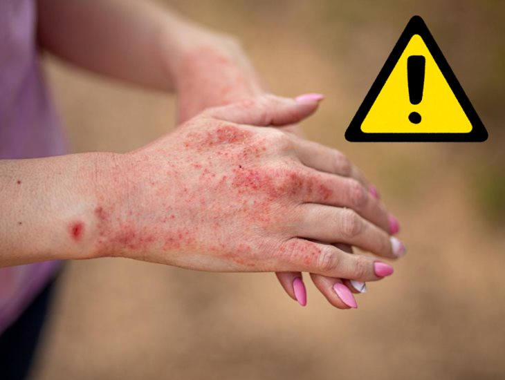 ¿Qué es el lupus?: IMSS Veracruz Norte llama a prevenir esta enfermedad