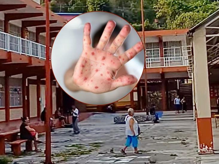 Brote de Coxsackie en primaria de Papantla