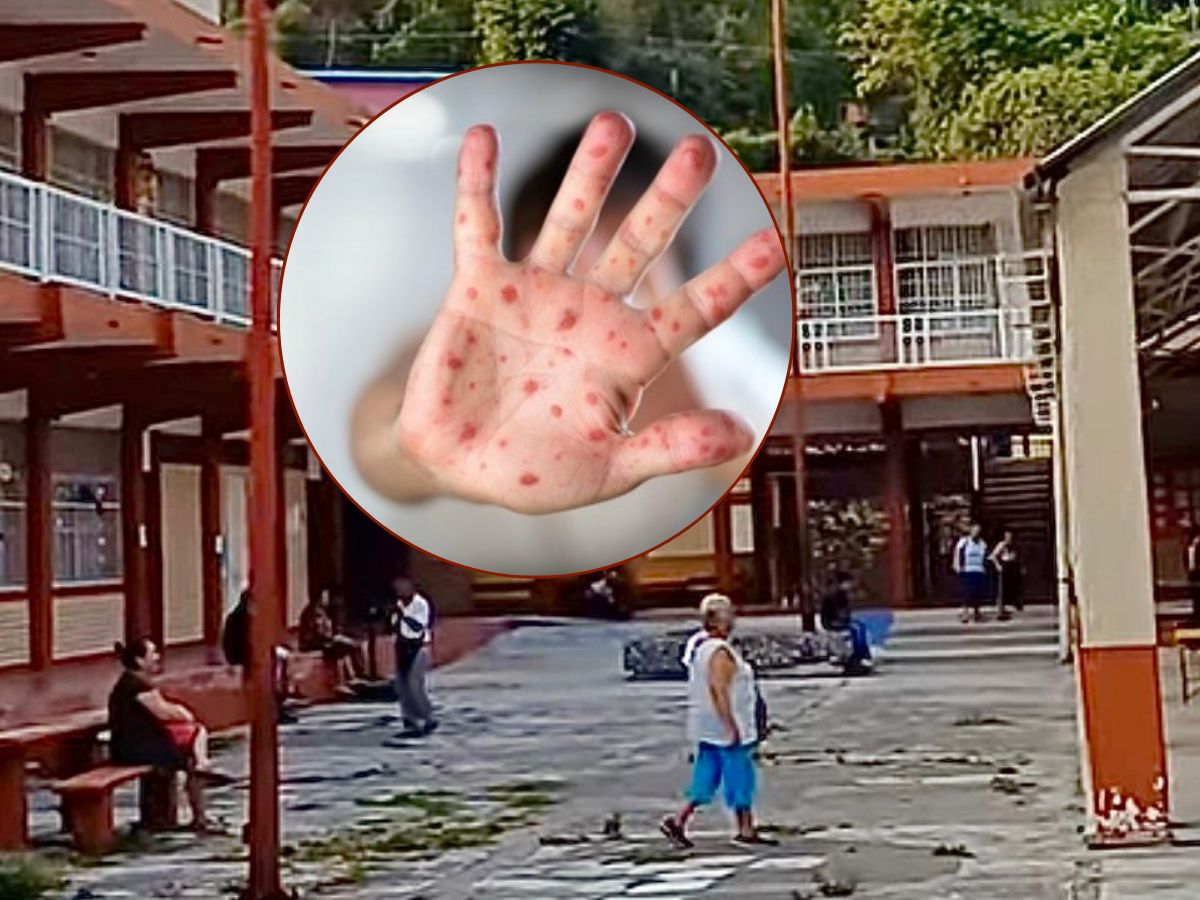 Brote de Coxsackie en primaria de Papantla