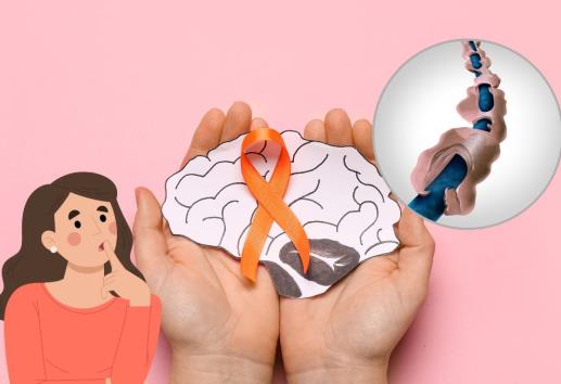 Día Mundial de la esclerosis múltiple; ¿es hereditaria?