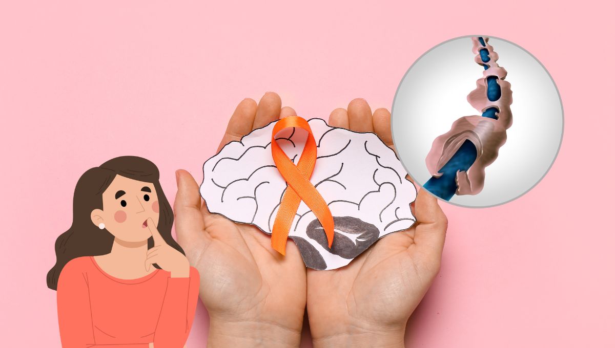 Día Mundial de la esclerosis múltiple; ¿es hereditaria?