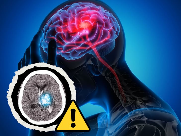 Cuidado, estos son los síntomas de sufrir un infarto cerebral