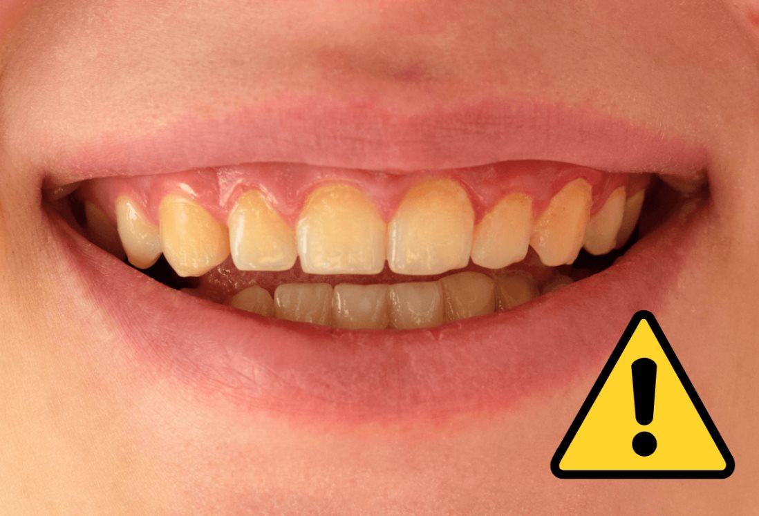5 alimentos que debes evitar consumir constantemente para no poner tus dientes amarillos