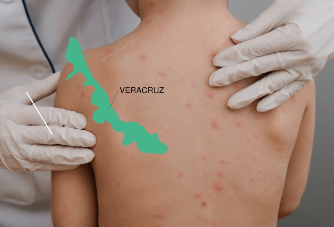 Más de mil 700 casos de varicela se han reportado en Veracruz, según reporte epidemiológico